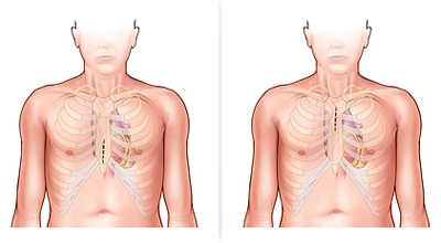 Minimally Invasive Cardiac Surgery