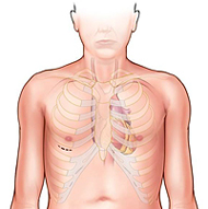 Incision on Bottom-left Part