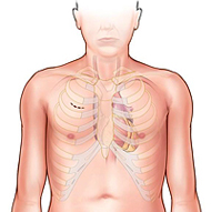 Incision on Left Part