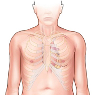 Incision on Bottom-right Part